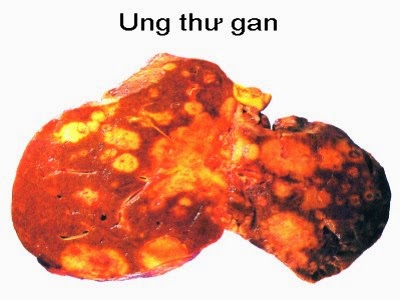 thao-duoc-teresa-herbs-ung-thu-gan