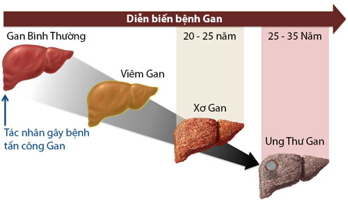 thao-duoc-teresa-herbs-giai-doan-cua-benh-gan
