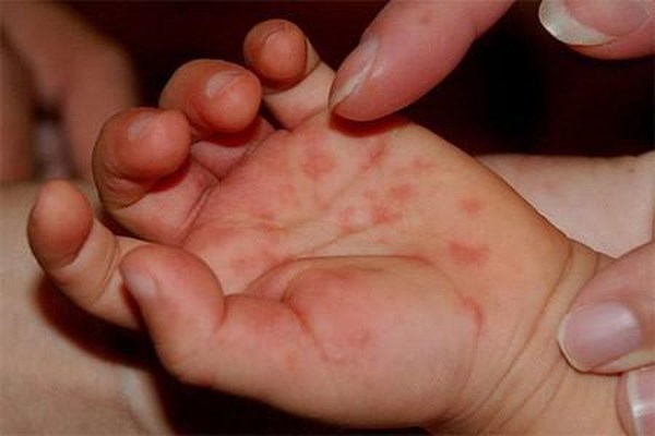 Sự thật về bệnh Tay-Chân-Miệng