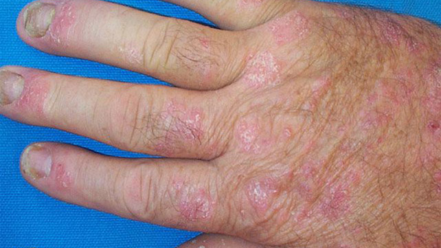 Bệnh Viêm khớp vảy nến – Yếu tố nguy cơ, triệu chứng và hướng điều trị