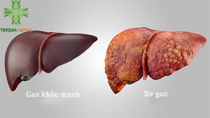 Xơ gan dấu hiệu nguyên nhân và hướng điều trị bệnh