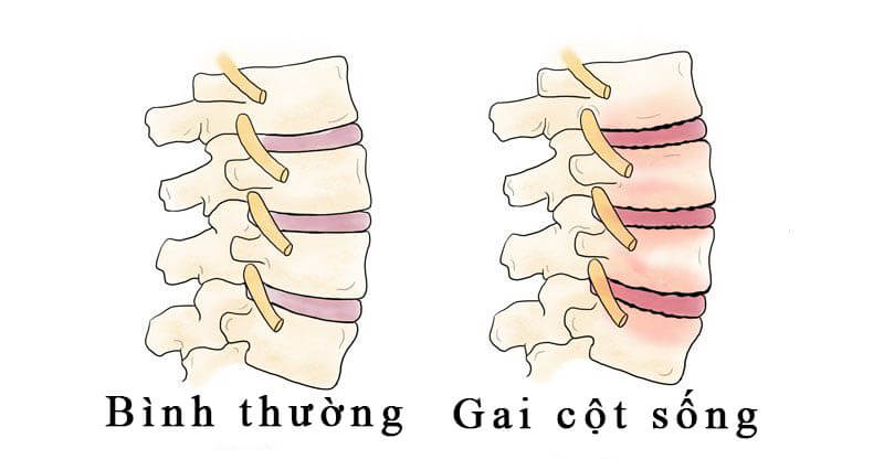 Gai cột sống – Nguyên nhân, giải pháp điều trị