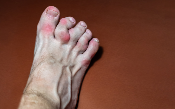 triệu chứng của bệnh gout