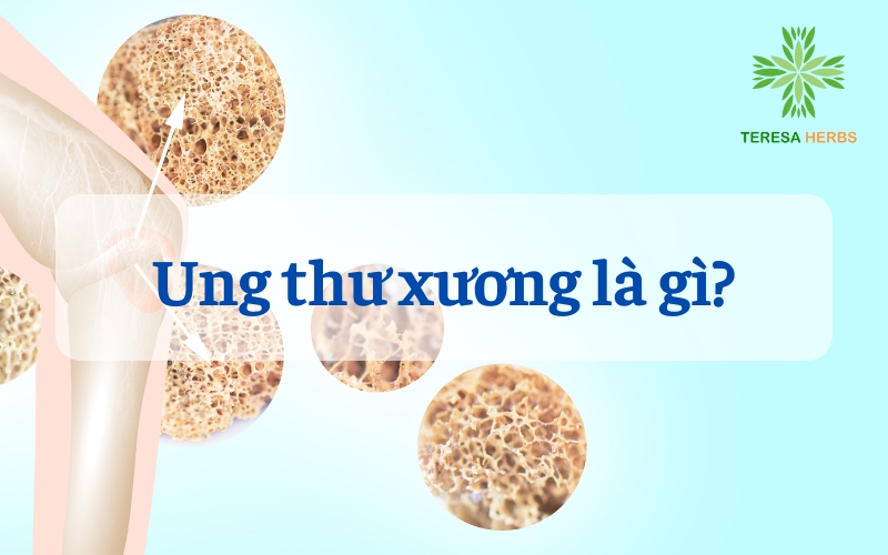 (Tiếng Việt) UNG THƯ XƯƠNG LÀ GÌ? NHỮNG ĐIỀU CẦN BIẾT