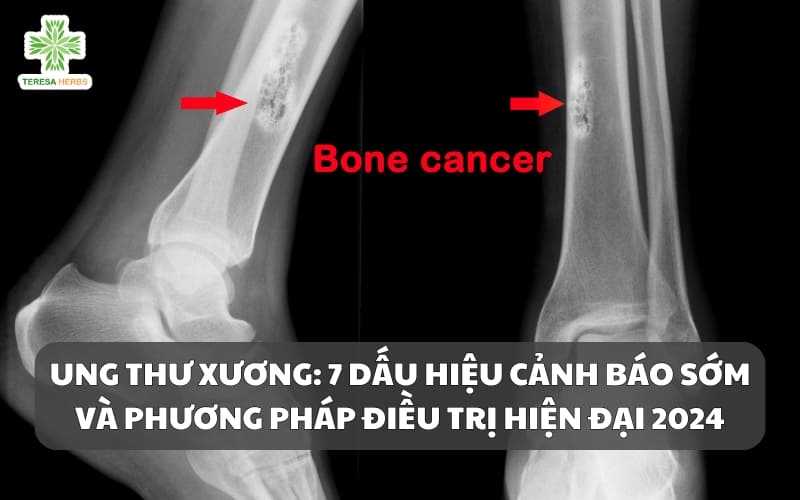 Ung Thư Xương: 7 Dấu Hiệu Cảnh Báo Sớm và Phương Pháp Điều Trị Hiện Đại 2024